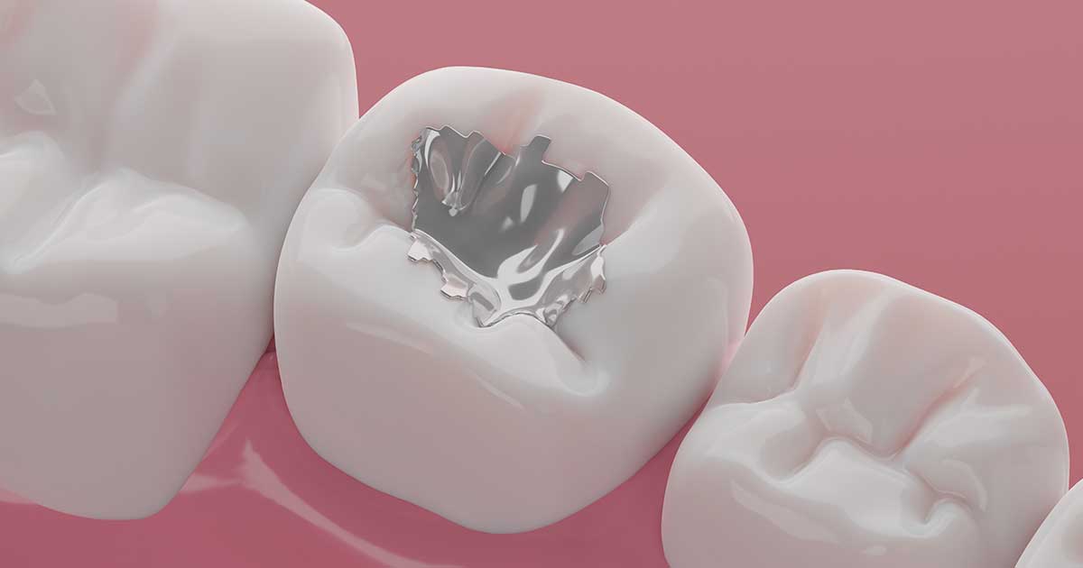 Mercury Amalgam Fillings