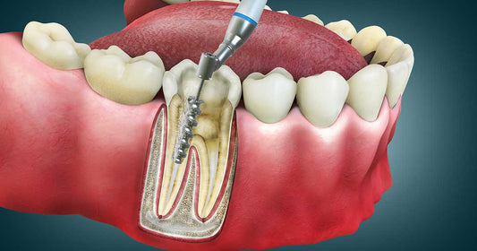 The Hidden Dangers of Root Canals